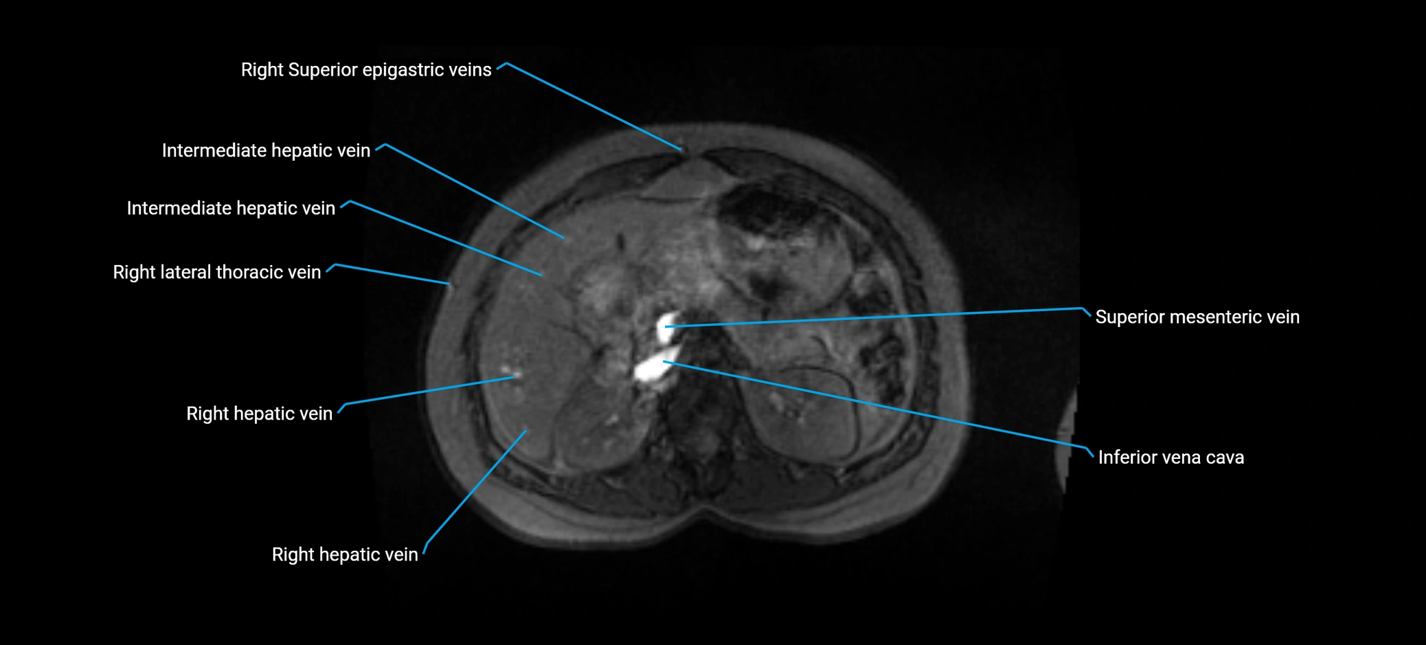 MRV abdomen pelvis & lower limb axial cross sectional anatomy labelled MRI image 55 (1).webp